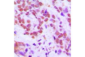 Immunohistochemical analysis of RFX3 staining in human breast cancer formalin fixed paraffin embedded tissue section.