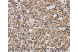Immunohistochemistry of Human gastric cancer using DCN Polyclonal Antibody at dilution of 1:30 (Decorin anticorps)