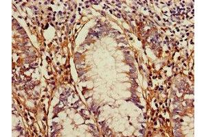 Immunohistochemistry of paraffin-embedded human colon cancer using ABIN7172274 at dilution of 1:100