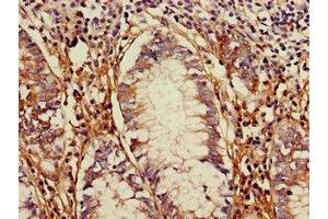 Immunohistochemistry of paraffin-embedded human colon cancer using ABIN7172274 at dilution of 1:100 (TLR5 anticorps  (AA 682-850))