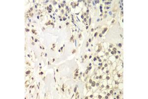Immunohistochemistry of paraffin-embedded human kidney cancer using USP7/HAUSP antibody (ABIN6132279, ABIN6150031, ABIN6150033 and ABIN6217612) at dilution of 1:200 (40x lens). (USP7 anticorps  (AA 206-1102))