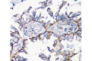 Immunohistochemistry of paraffin-embedded Human lung cancer using MMP16 Polyclonal Antibody at dilution of 1:100 (40x lens). (MMP16 anticorps)