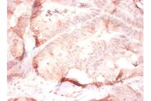 Immunohistochemistry of paraffin-embedded human colon cancer using ABIN7148243 at dilution of 1:50