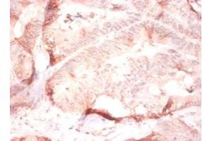 Immunohistochemistry of paraffin-embedded human colon cancer using ABIN7148243 at dilution of 1:50 (COL4a2 anticorps  (AA 1493-1712))