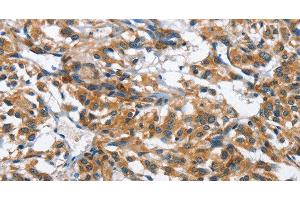 Immunohistochemistry of paraffin-embedded Human thyroid cancer tissue using BPI Polyclonal Antibody at dilution 1:50 (BPI anticorps)
