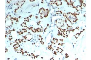 Formalin-fixed, paraffin-embedded human Thyroid stained with PAX8 Recombinant Mouse Monoclonal Antibody (rPAX8/1492). (Recombinant PAX8 anticorps  (AA 60-261))