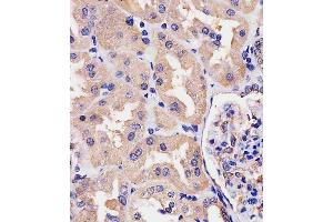 (ABIN390742 and ABIN2841007) staining Villin-1 in human kidney tissue sections by Immunohistochemistry (IHC-P - paraformaldehyde-fixed, paraffin-embedded sections). (Villin 1 anticorps  (N-Term))
