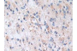 Detection of AKAP11 in Human Glioma Tissue using Polyclonal Antibody to A Kinase Anchor Protein 11 (AKAP11)