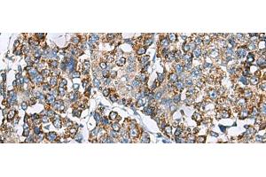 Immunohistochemistry of paraffin-embedded Human liver cancer tissue using PRELID3B Polyclonal Antibody at dilution of 1:90(x200)