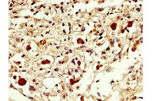 IHC image of ABIN7152301 diluted at 1:300 and staining in paraffin-embedded human melanoma performed on a Leica BondTM system. (EXOSC1 anticorps  (AA 587-762))
