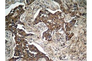Immunohistochemical analysis of paraffin-embedded human lung carcinoma tissue, using HER2 (Phospho-Tyr1248) Antibody. (ErbB2/Her2 anticorps  (pTyr1248))