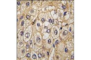 Formalin-fixed and paraffin-embedded human hepatocarcinoma tissue reacted with EphA7 antibody, which was peroxidase-conjugated to the secondary antibody, followed by DAB staining.