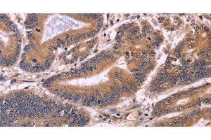Immunohistochemistry of paraffin-embedded Human colon cancer tissue using S100A13 Polyclonal Antibody at dilution 1:40 (S100A13 anticorps)