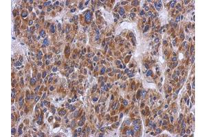 IHC-P Image Immunohistochemical analysis of paraffin-embedded human hepatoma, using PTS, antibody at 1:500 dilution. (PTS anticorps)
