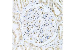 Immunohistochemistry of paraffin-embedded human kidney cancer using CBFB Antibody (ABIN6130041, ABIN6138000, ABIN6138001 and ABIN6220926) at dilution of 1:200 (40x lens).