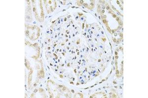 Immunohistochemistry of paraffin-embedded human kidney cancer using CBFB Antibody (ABIN6130041, ABIN6138000, ABIN6138001 and ABIN6220926) at dilution of 1:200 (40x lens). (CBFB anticorps  (AA 1-182))