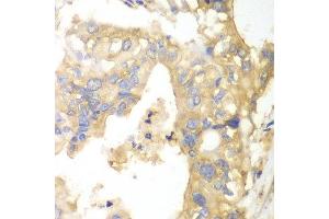 Immunohistochemistry of paraffin-embedded human liver cancer using PYGB antibody at dilution of 1:100 (x40 lens).