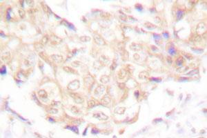 Immunohistochemical analysis of paraffin-embedded human breast cancer tissue using UBR5 polyclonal antibody .