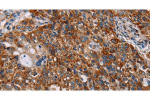 Immunohistochemistry of paraffin-embedded Human lung cancer tissue using ALG2 Polyclonal Antibody at dilution 1:35 (ALG2 anticorps)