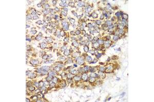 Immunohistochemistry of paraffin-embedded human esophageal cancer using TFAM antibody. (TFAM anticorps)