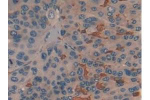 Detection of PKM2 in Human Liver cancer Tissue using Polyclonal Antibody to Pyruvate kinase isozymes M2 (PKM2)