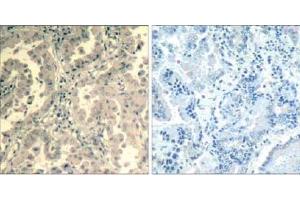 Immunohistochemical analysis of paraffin-embedded human lung carcinoma tissue using stat2 (Ab-690) Antibody (E021536). (STAT2 anticorps)