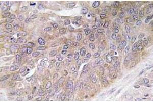 Immunohistochemistry (IHC) analyzes of VEGF-D antibody in paraffin-embedded human lung carcinoma tissue. (VEGFD anticorps)