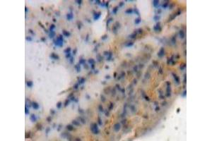Used in DAB staining on fromalin fixed paraffin-embedded Lung tissue (ADAMTS4 anticorps  (AA 437-575))