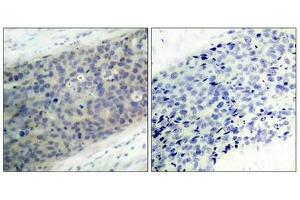 Immunohistochemical analysis of paraffin-embedded human breast carcinoma tissue using LIMK2(Phospho-Thr505) Antibody(left) or the same antibody preincubated with blocking peptide(right). (LIMK2 anticorps  (pThr505))