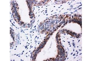 IHC-P: PI3K antibody testing of human breast cancer tissue (PIK3R1 anticorps  (AA 447-461))