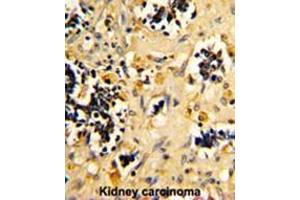 Formalin-fixed and paraffin-embedded human kidney carcinoma reacted with NDUFS4 Antibody (C-term), which was peroxidase-conjugated to the secondary antibody, followed by DAB staining. (NDUFS4 anticorps  (C-Term))