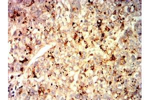 Immunohistochemical analysis of paraffin-embedded liver cancer tissues using GPC3 mouse mAb with DAB staining. (Glypican 3 anticorps  (AA 55-200))