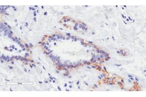 Immunohistochemical staining of paraffin embedded human breast tissue using anti-erbB-2 antibody. (Recombinant ErbB2/Her2 (Trastuzumab Biosimilar) anticorps)