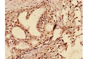 Immunohistochemistry of paraffin-embedded human breast cancer using ABIN7147346 at dilution of 1:100