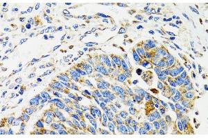 Immunohistochemistry of paraffin-embedded Human esophageal cancer using SH2B1 Polyclonal Antibody at dilution of 1:100 (40x lens). (SH2B1 anticorps)