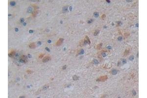 Detection of NT5C3 in Human Glioma Tissue using Polyclonal Antibody to 5'-Nucleotidase, Cytosolic III (NT5C3)