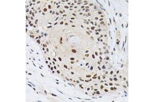 Immunohistochemistry of paraffin-embedded human esophageal cancer using KPNA4 Antibody.