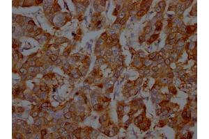 IHC image of ABIN7127799 diluted at 1:100 and staining in paraffin-embedded human breast cancer performed on a Leica BondTM system. (Recombinant S1A9 anticorps)
