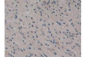 Detection of CARD9 in Human Glioma Tissue using Polyclonal Antibody to Caspase Recruitment Domain Family, Member 9 (CARD9) (CARD9 anticorps  (AA 26-283))