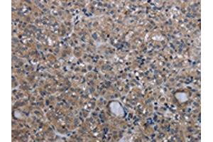 The image on the left is immunohistochemistry of paraffin-embedded Human thyroid cancer tissue using ABIN7130197(MCM3AP Antibody) at dilution 1/30, on the right is treated with fusion protein. (GANP anticorps)
