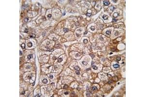 IHC analysis of FFPE human hepatocarcinoma tissue stained with BMPR2 antibody