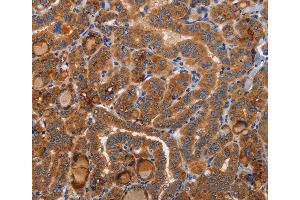 Immunohistochemistry of Human colon cancer using BMP6 Polyclonal Antibody at dilution of 1:40 (BMP6 anticorps)