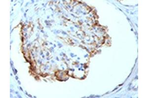IHC testing of formalin-fixed, paraffin-embedded human kidney stained with WT1 antibody (clone WT1/857). (WT1 anticorps)