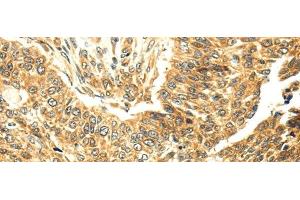 Immunohistochemistry of paraffin-embedded Human lung cancer tissue using SERPINA12 Polyclonal Antibody at dilution 1:40 (SERPINA12 anticorps)