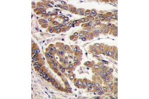 Formalin-fixed and paraffin-embedded human lung carcinoma tissue reacted with PKC zeta antibody (N-term), which was peroxidase-conjugated to the secondary antibody, followed by DAB staining. (PKC zeta anticorps  (N-Term))