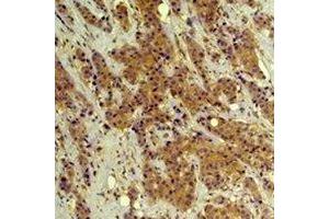 Immunohistochemical analysis of ERK1/2 staining in human breast cancer formalin fixed paraffin embedded tissue section. (ERK1/2 anticorps)