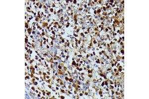 Immunohistochemistry of paraffin-embedded human appendix using DUT antibody (ABIN7266736) at dilution of 1:100 (40x lens). (Deoxyuridine Triphosphatase (DUT) (AA 89-252) anticorps)