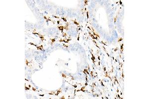 Immunohistochemistry of paraffin-embedded Human colon carcinoma using CD74 antibody (ABIN7267759) at dilution of 1:100 (40x lens). (CD74 anticorps)