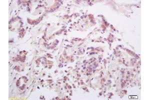 Formalin-fixed and paraffin embedded human gastric carcinoma labeled with Rabbit Anti OPGL/RANKL/ODF Polyclonal Antibody, Unconjugated (ABIN672696) at 1:200 followed by conjugation to the secondary antibody and DAB staining (RANKL anticorps  (AA 210-317))
