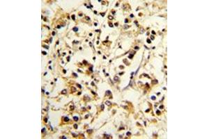 Formalin-fixed and paraffin-embedded human breast carcinoma reacted with CD158d / KIR2DL4 Antibody (C-term) followed which was peroxidase-conjugated to the secondary antibody, followed by DAB staining. (KIR2DL4/CD158d anticorps  (C-Term))